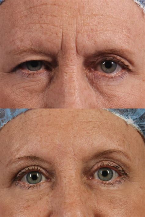 Brow Lift Dr Brett Kotlus