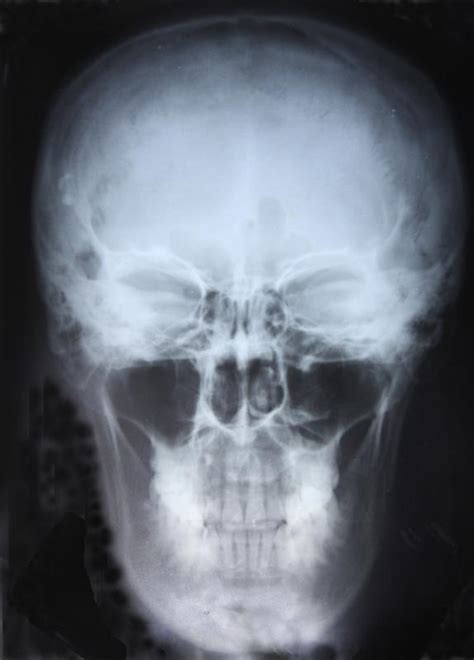 What are the Frontal Sinuses? (with pictures)