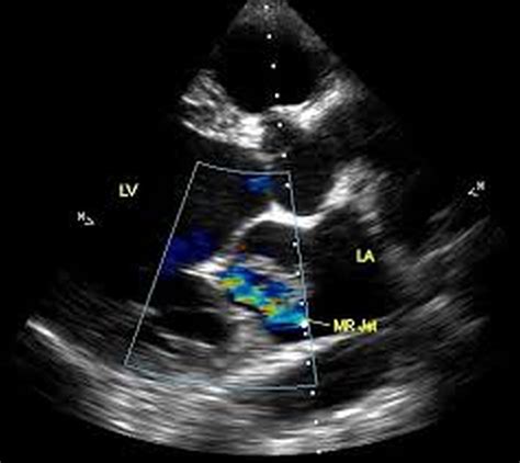 Left Atrial Myxoma Echocardiogram In Parasternal Long Axis View All