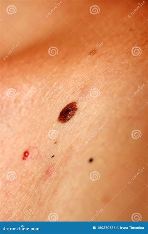 Brown Birthmark Brown Mole Large Size Stock Photo Image Of Epidermal