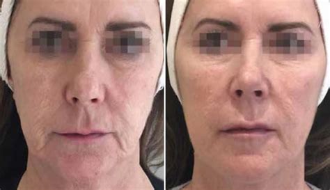 Profilo Face Before And After Mid Yorkshire Skin Clinic