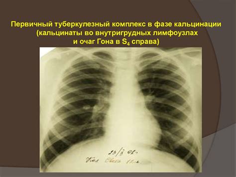 Туберкулезная интоксикация. Туберкулез внутригрудных лимфатических ...