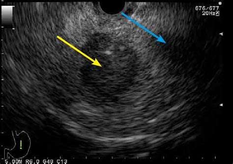 Linear Endoscopic Ultrasound Image Of A 30 Mm Heterogeneous Mass In The Download Scientific