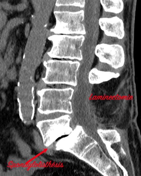 Pathologies Lombaires