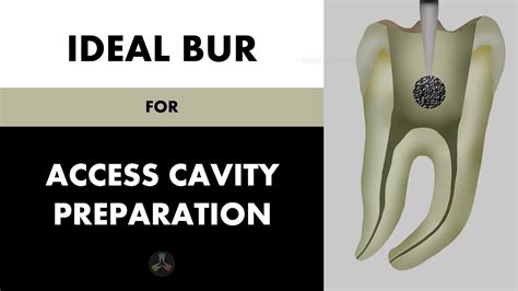 Ideal Bur For Access Cavity Preparation Youtube