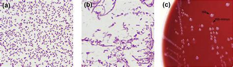 Haemophilus Influenzae Serotype B Hib Infection Pictures