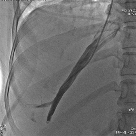 Post Biopsy Hepatic Venogram Anteroposterior View Showing No Evidence