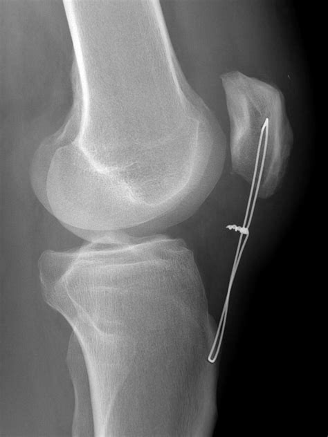 Patella Tendon Rupture The Bone School