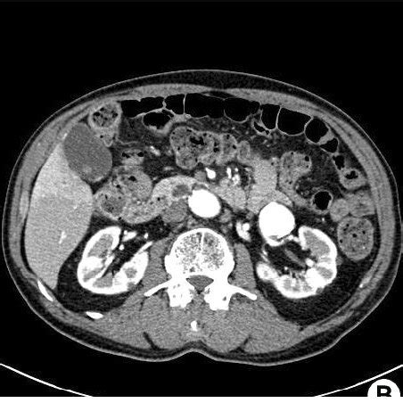 Preoperative Contrast Enhanced Computed Tomography Scan With