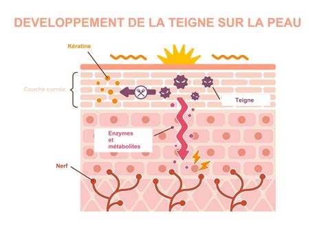 Teigne quels sont les premiers symptômes et les traitements