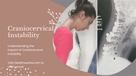 Understanding craniocervical instability
