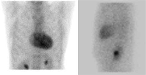 99m Tc Hydroxymethylene Diphosphonate Scintigraphy Showing Significant