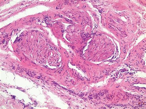 Median Palatal Cyst Histology