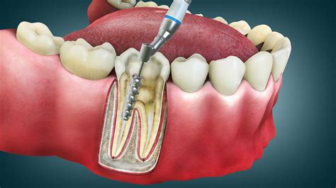 Root Canal Therapy Risks And Complications Amazing Smiles