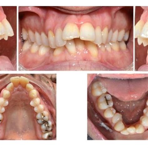 Pdf Consideration Of Maxillary Skeletal Expansion Mse And