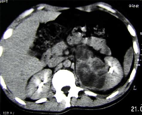 Preoperative Ct Scan Download Scientific Diagram