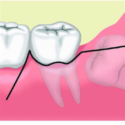 (PDF) Flap Techniques in Dentoalveolar Surgery