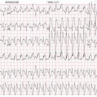 The 12 Lead Electrocardiogram ECG Tracing 1 H After Admission To The