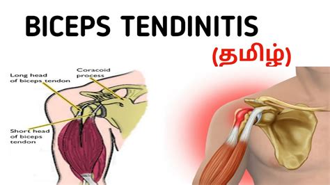 Biceps Tendinitis Causes Risk Factors Symptoms Investigation