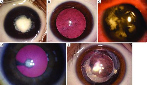 Congenital Cataract Morphology And Main Postoperative Complication Of