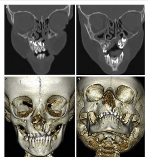 Figure 1 From Rhinoplastie De Fente Primaire Et Secondaire Semantic