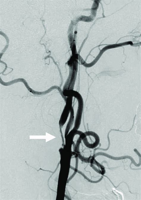 Right Common Carotid Angiography Before Cas Lateral View Showing Long Download Scientific