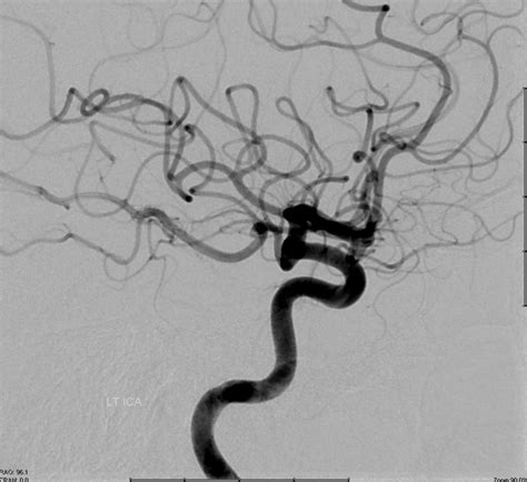 Internal Carotid Artery and Its Aneurysms | neuroangio.org