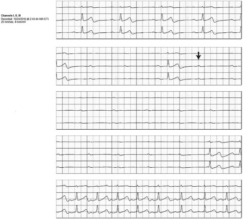 Complete Atrioventricular Heart Block From An Epilepsy Treatment