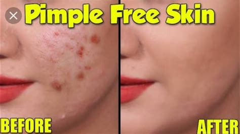 How To Remove Pimples In 5 Day S Get Rid Of Pimples Fast In Telugu