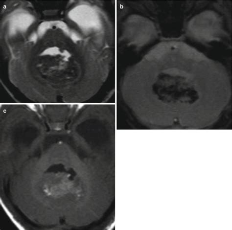 Imaging Of Medulloblastoma Neupsy Key