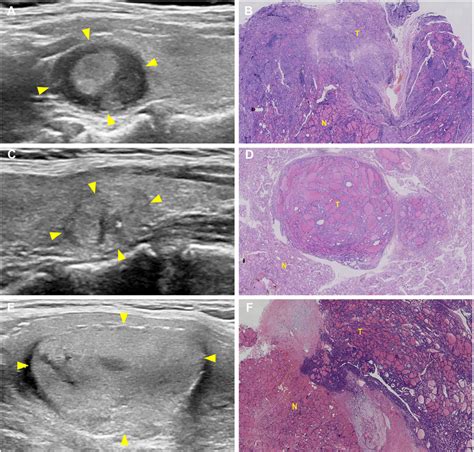 Three Cases Of Thyroid Nodules Occurred With Kras Nras And Tert Download Scientific Diagram