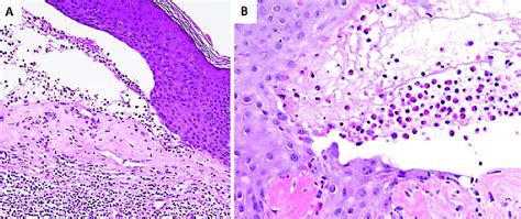 A Subepidermal Blister The Inflammatory Infiltrate Is Polymorphous Download Scientific