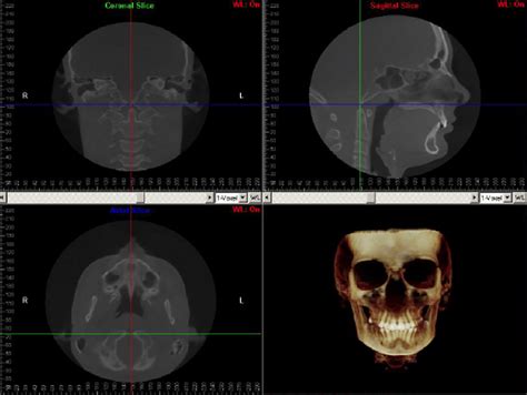 Mid Sagittal Cbct Evaluation Of Spheno Occipital Synchondrosis While Download Scientific