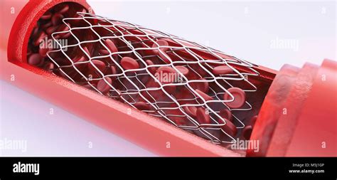 Angioplastia con colocación de stent 3D rendering Fotografía de stock