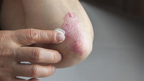 Hidradenitis Supurativa Qué Es Y Cómo Combatir Esta Enfermedad Poco Conocida Pero Frecuente