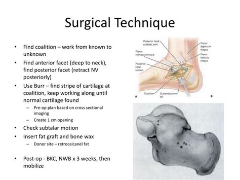 PPT - Tarsal Coalition PowerPoint Presentation - ID:6578156