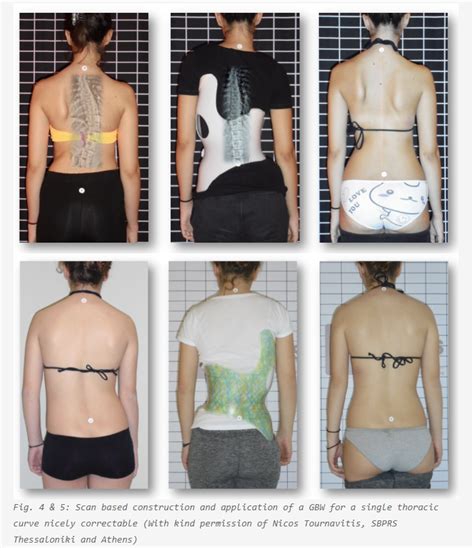 Scoliosis Brace Before And After