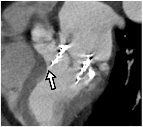 Post Procedural Structural Heart CT Imaging TAVR TMVR And Other