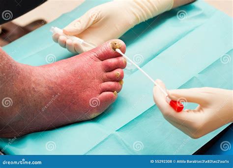 Treatment For Severe Fungal Nail Infection