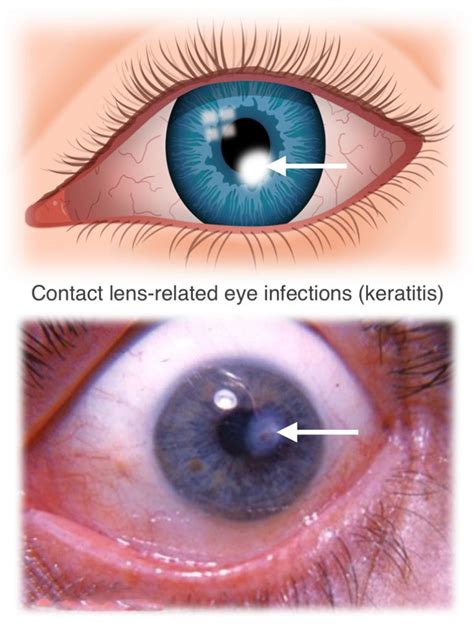 Contact Lens Related Eye Infections Fort Worth Eye Associates