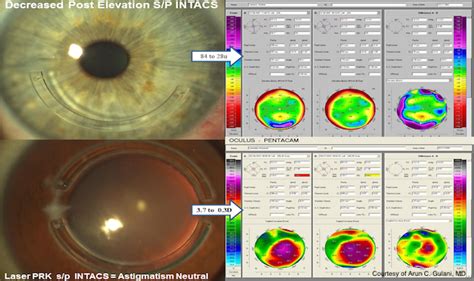 Intacs Keratoconus