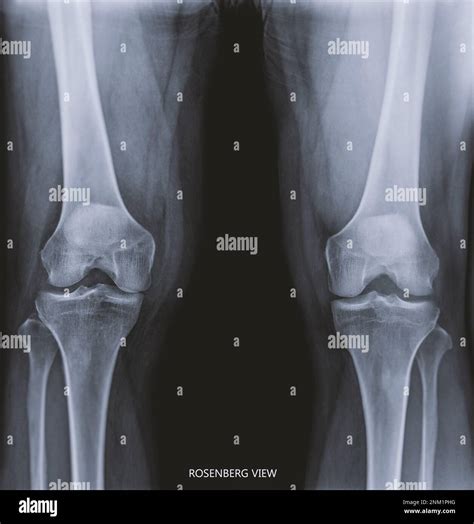 Film X Ray Both Knee Joint Ap View Name Is Rosenberg View For Diagnosis