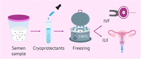 Sperm Freezing Indications Process Result And Price