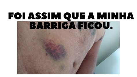 Como Era Meu Dia No Hospital Para Operar A Ponte De Safena Youtube