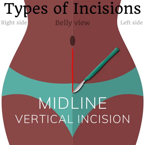 Types Of Surgical Incisions SterilizationAunty