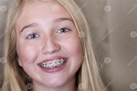 Fille De Ladolescence Avec Des Accolades Sur Ses Dents Photo Stock