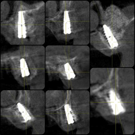 Implantation On Upper Jaws With Full Adentia Using P7D Conical