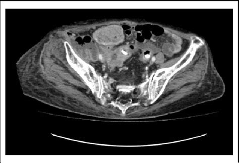 Figure 3 From A Rare And Fatal Cause Of Right Iliac Fossa Pain—when Retroperitoneal Necrotizing