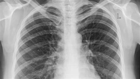 Pneumonia Viral O Que Sintomas Diagn Stico E Tratamento