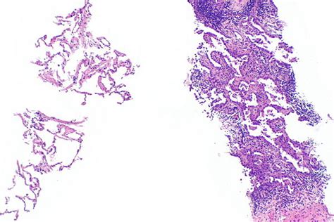 Adenocarcinoma Of The Lung Libre Pathology